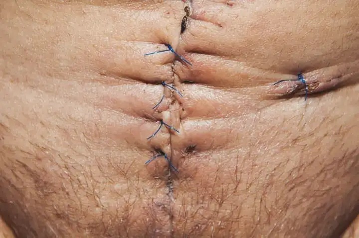 Abdominoplastia - Cirurgia Plástica do Abdômen e Barriga