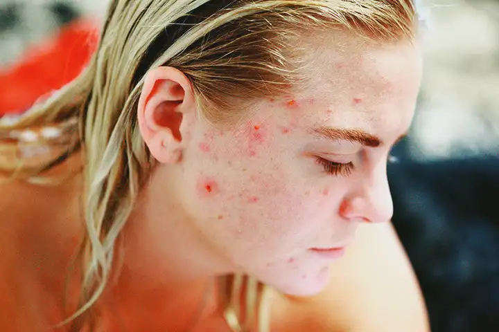 Acne Conglobata | Causas, Sintomas e Tratamento