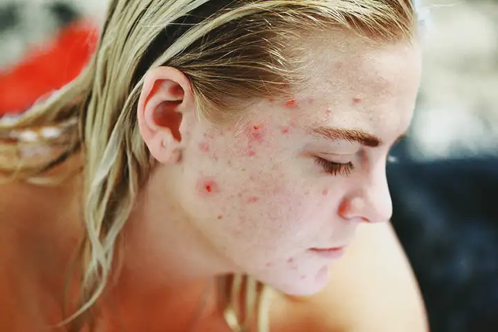 Acne Hormonal | Causas, Sintomas e Tratamento