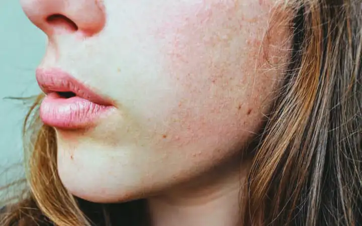 Alergias que causam acne