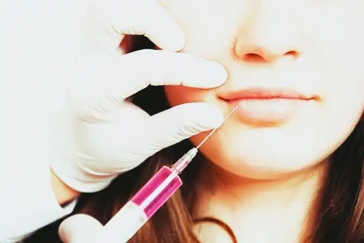 Aumento labial (Bioplastia labial) | Preenchimento labial