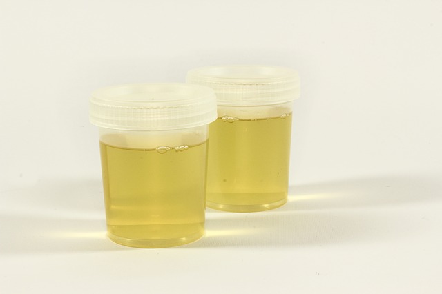Causas da urina com cheiro forte | Urina com odor forte