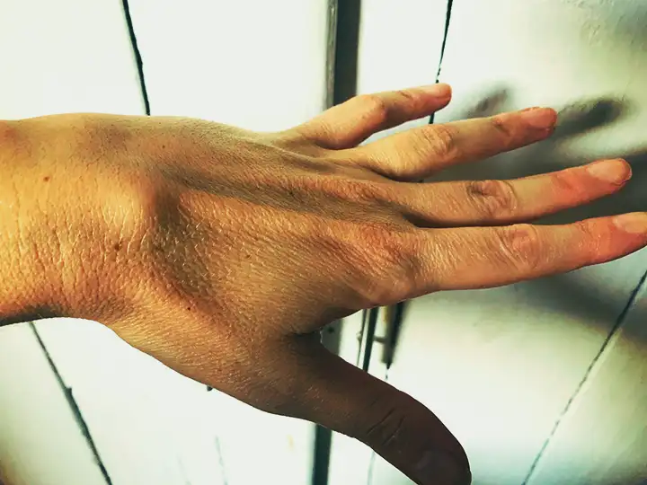 Cisto no pulso | Protuberância na parte traseira da mão