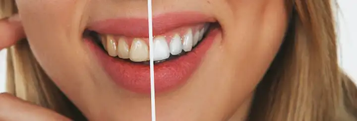 Clareamento Dental | Como faz para clarear os dentes?
