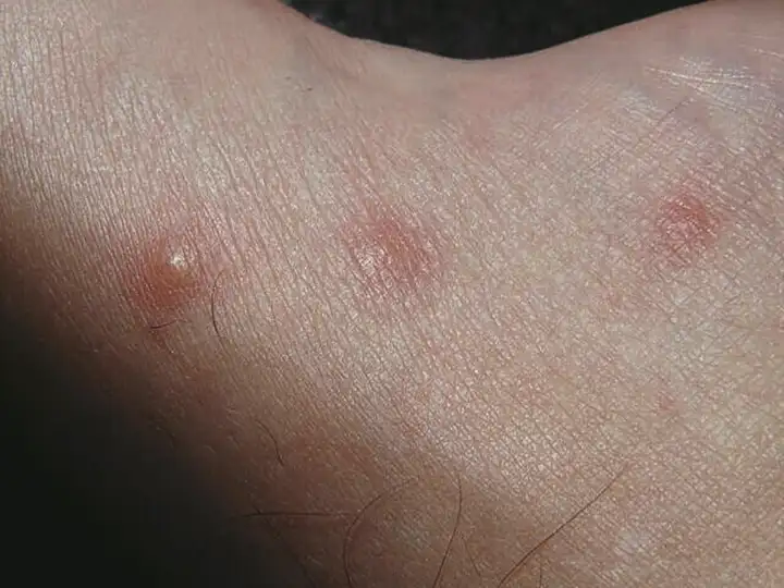 Disidrose - Bolhas nas Mãos e Bolhas nos Pés