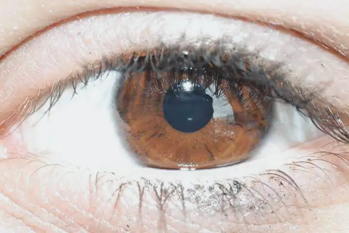 Dor No Olho - Sensação De Algo No Meu Olho