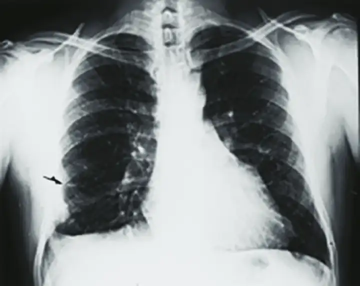 Embolia Pulmonar | Causas, Sintomas e Tratamento