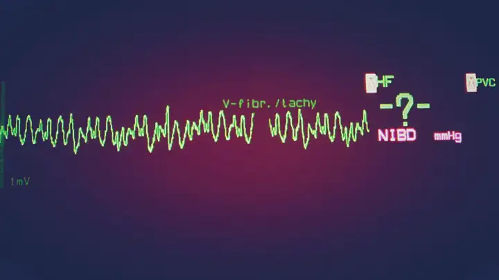 Fibrilação Ventricular | Problema do ritmo cardíaco