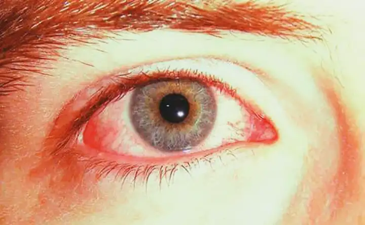 Mancha Vermelha no Olho - Hemorragia Subconjuntival