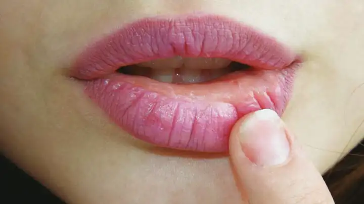 O que é Herpes Labial?