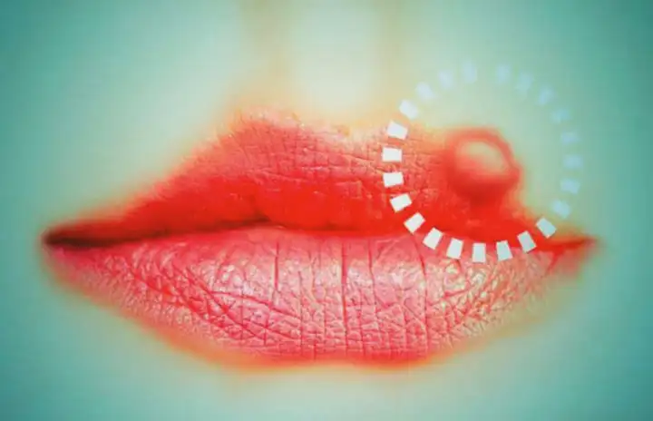 Herpes Labial | Sinais e Sintomas de Herpes na Boca