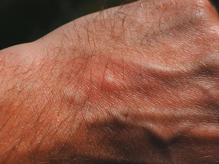 Infecções bacterianas comuns da pele | Comuns e como tratar