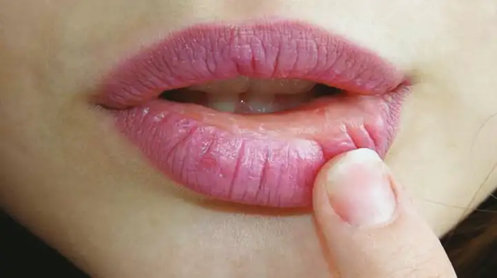 Lábios Inchados | Sintomas, Alergias e Tratamento