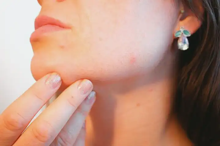 O que é Acne (Espinhas)