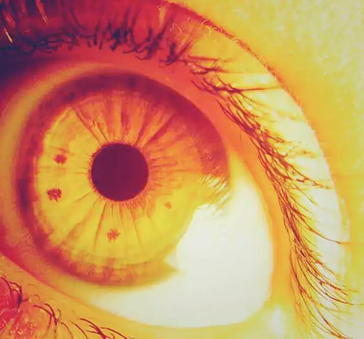 Olhos Amarelos - Quais as Causas dos Olhos Amarelados (Icterícia)?