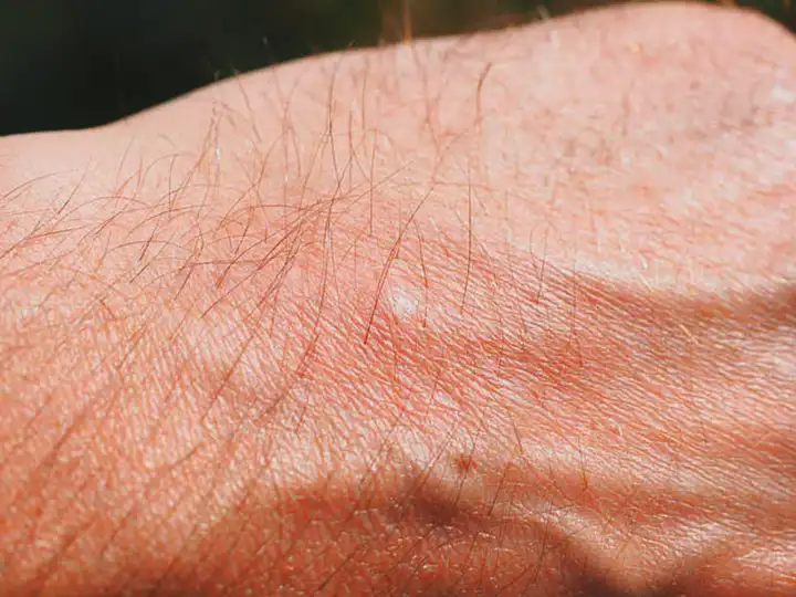 Pústulas na pele | Sintomas, Causas e Tratamento 