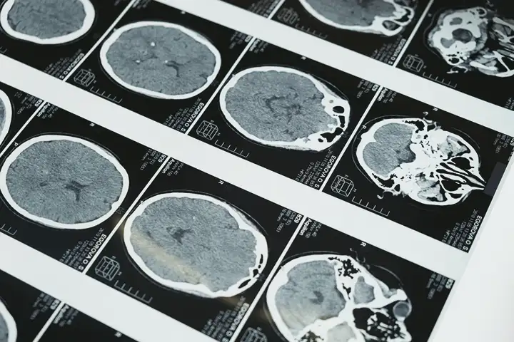 Que áreas do cérebro são afetadas pela esquizofrenia?
