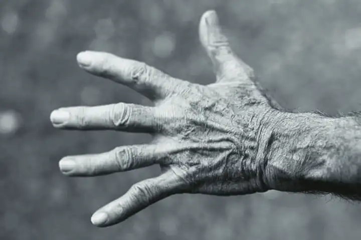 Sintomas de artrite reumatoide nas mãos e nos dedos
