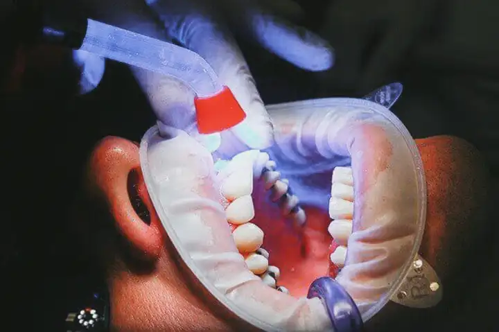 Tratamento de canal para o nervo do dente